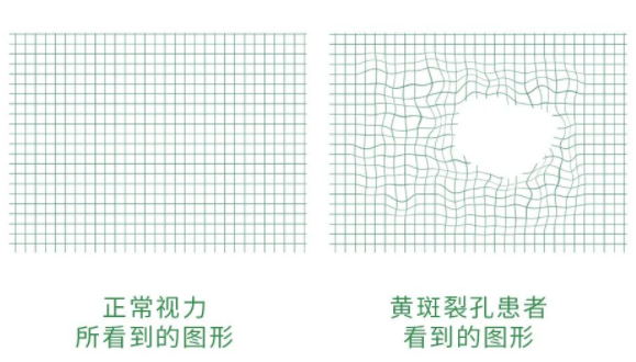 黄斑裂孔视界.jpg