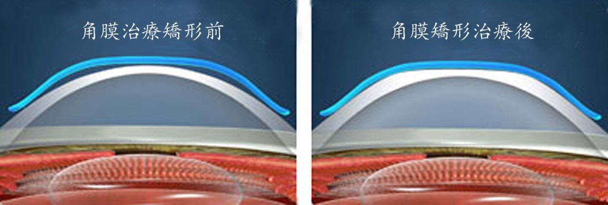 关于,角膜,塑形,镜你,究竟,知道,多少,角膜,